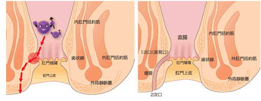 あな痔の正体は肛門の周りにできた管(くだ)！