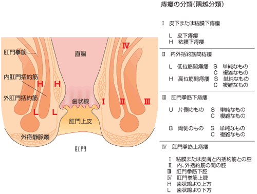 痔瘻(あな痔)の分類(隅越分類)