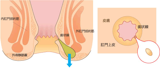 肛門周囲の膿瘍で、痔瘻(あな痔)が判明する