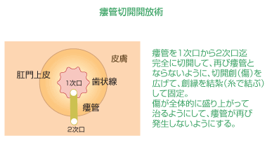 瘻管切開開放術