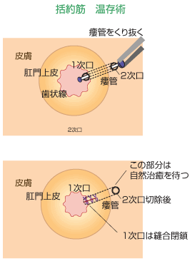 括約筋温存術