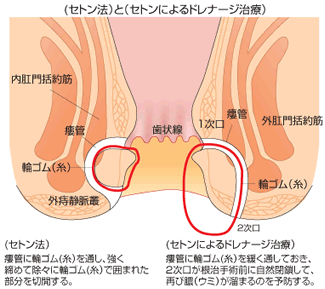 セトン法：輪ゴム法