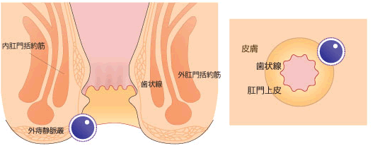 血栓性外痔核