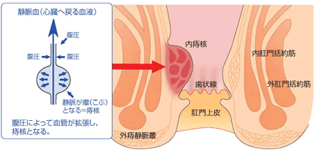 痔核(いぼ痔)とは・・・？