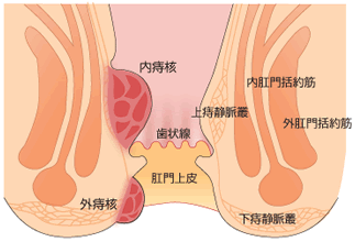 内痔核と外痔核