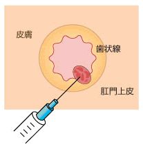 硬化剤注射療法