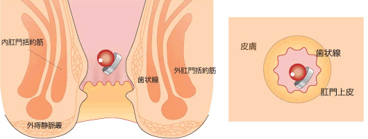 痔核結紮（けっさつ）療法（マックギブニー法）