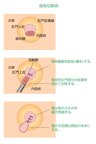 結紮(けっさつ)切除術による痔核治療