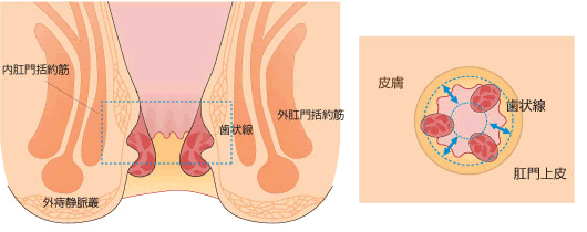 PPH法(Procedure for Prolapse and Hemorrhoids)