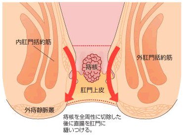 ホワイトヘッド肛門とは・・・？