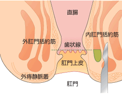 側方内括約筋切開術：LSIS(エルエスアイエス)