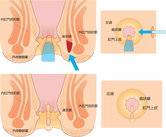裂肛切除と側方内括約筋切開術