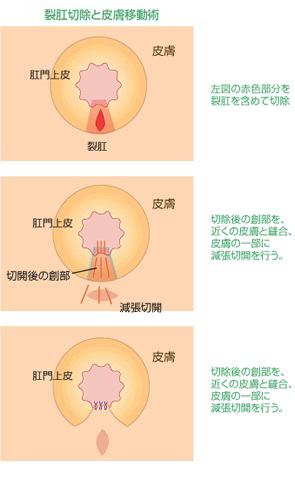 裂肛切除と皮膚弁移動術(Sliding Skin Graft:SSG)