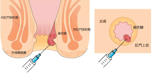 注射のみで痔核が消退！