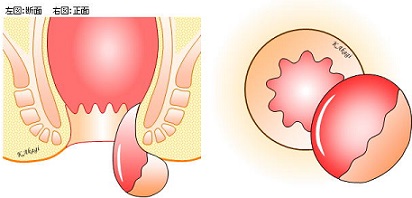 激しい痛み！嵌頓痔核をご存知ですか？