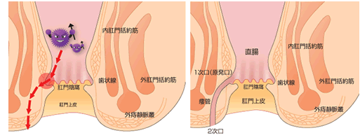 痔瘻診断のための参考図